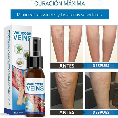 DILE ADIOS A LAS VARICES Y ARAÑITAS CON EL SPRAY VARICOSE VEINS 😲